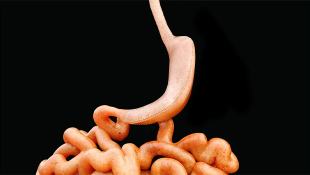 اسلیو معده