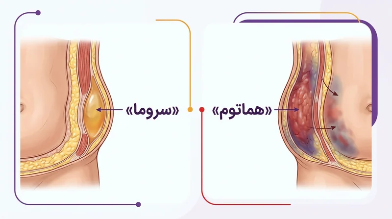 اینفوگرافیک علائم سروما و هماتوم در درمان درد بعد از ابدومینوپلاستی
