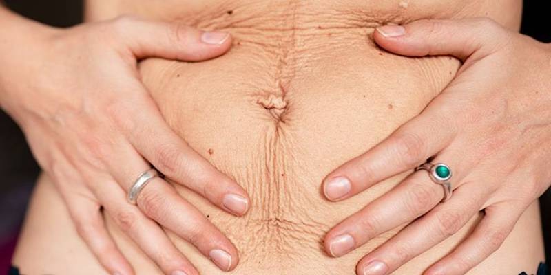 جراحی زیبایی شکم بعد از سزارین