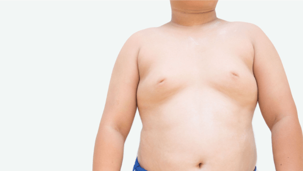 تفاوت ژنیکوماستی با چربی