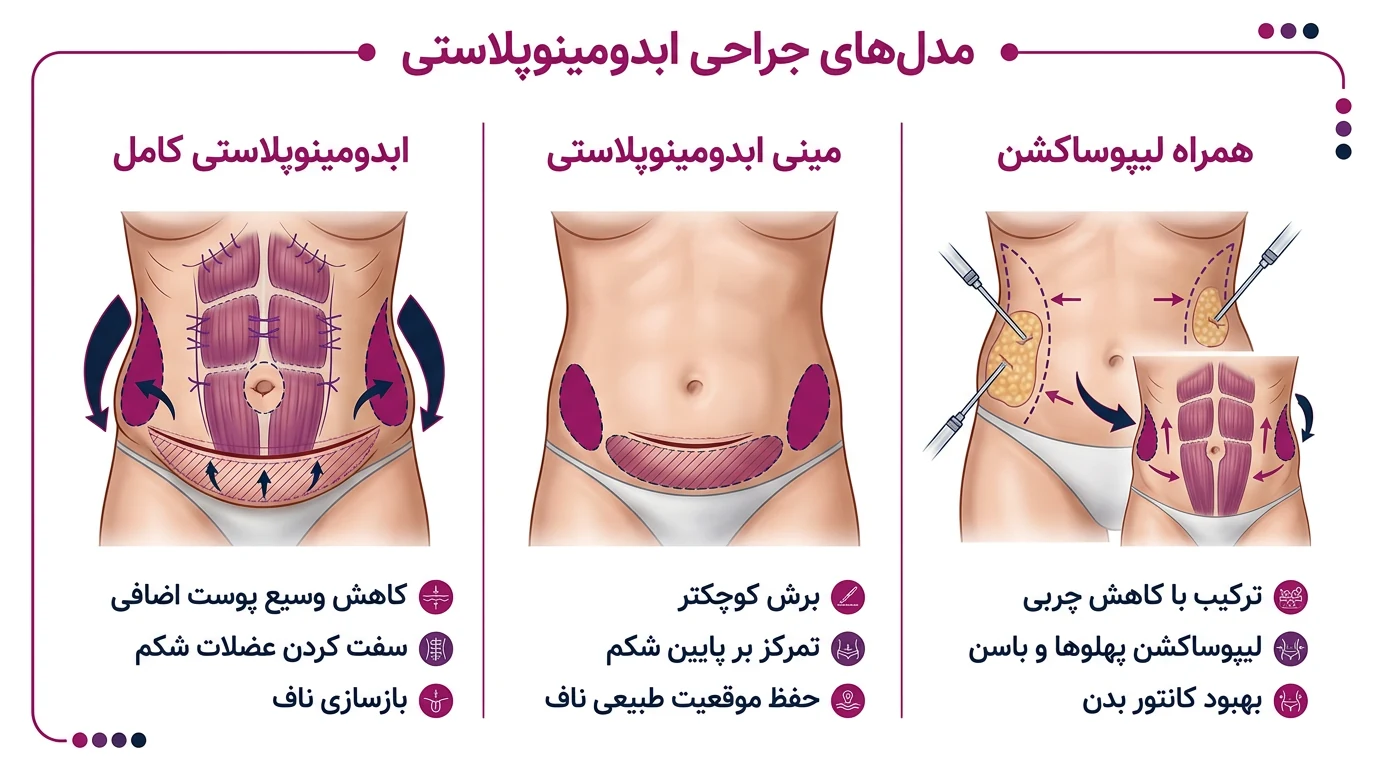 انواع ابدومینوپلاستی در کرج شامل کامل، مینی و همراه لیپوساکشن